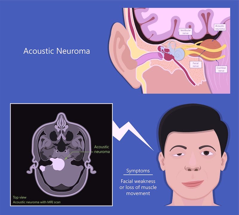 acoustic neuromas symptoms