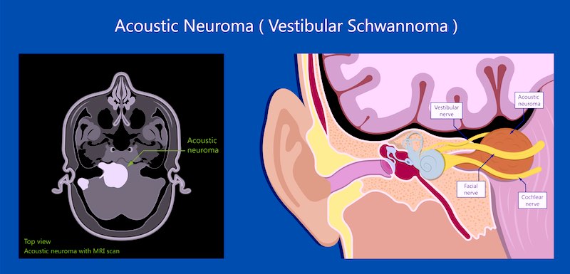 acoustic neuromas vestibular schwannoma