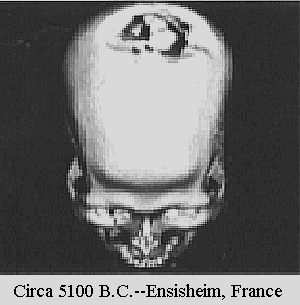 anicent skull that had brain surgery done it