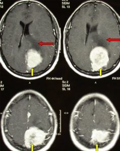 ct scan of a benign tumor