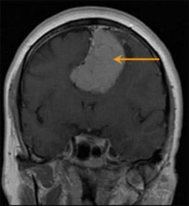 mri scan of tumor