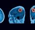 benign brain tumor mri scan