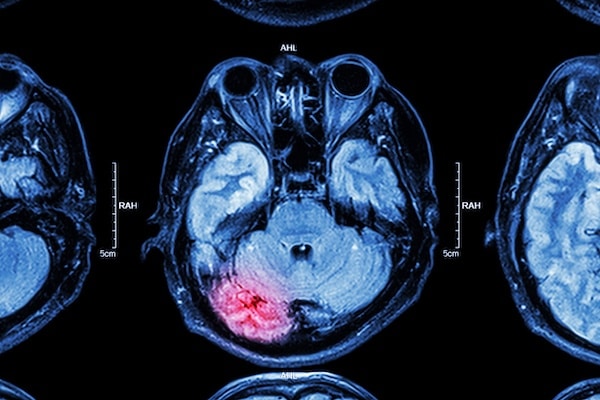 MRI scan of brain