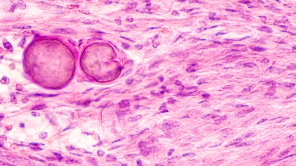 Stereotactic Brain Biopsy Smear Meningioma